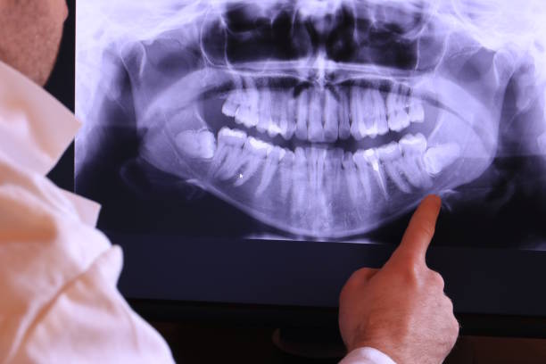 Best Emergency Wisdom Teeth Removal in Geneva, IN